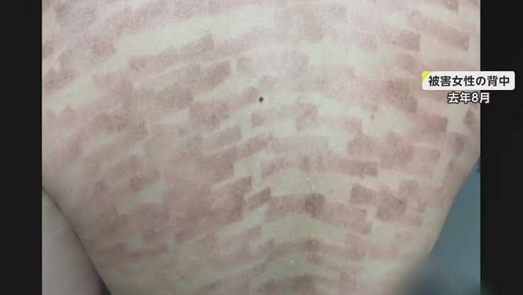 A photo of the inflammation caused by burns on the back due to hair removal